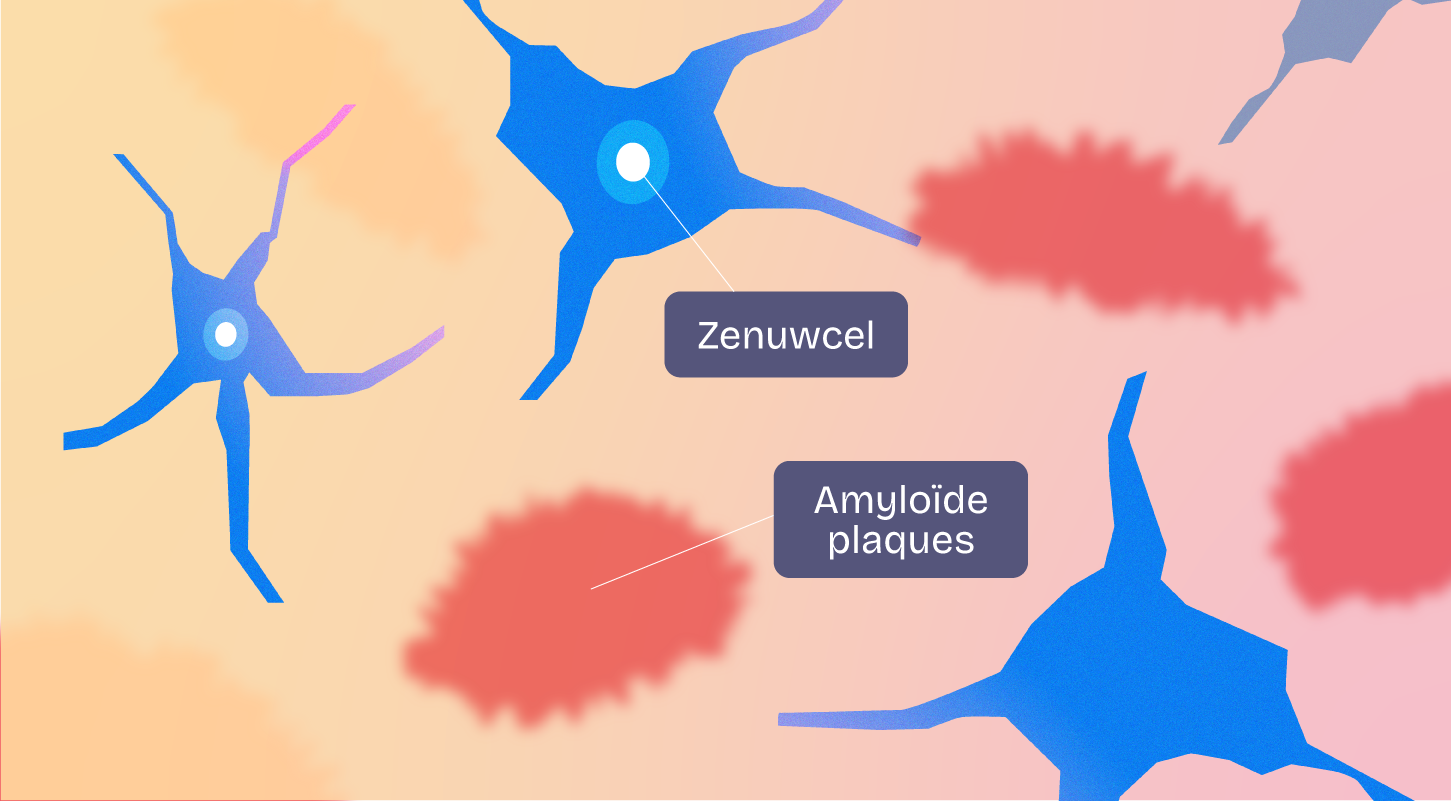 Illustration showing blue nerve cells labeled 'Zenuwcel' and red amyloid plaques labeled 'Amyloïde plaques' on a gradient background.