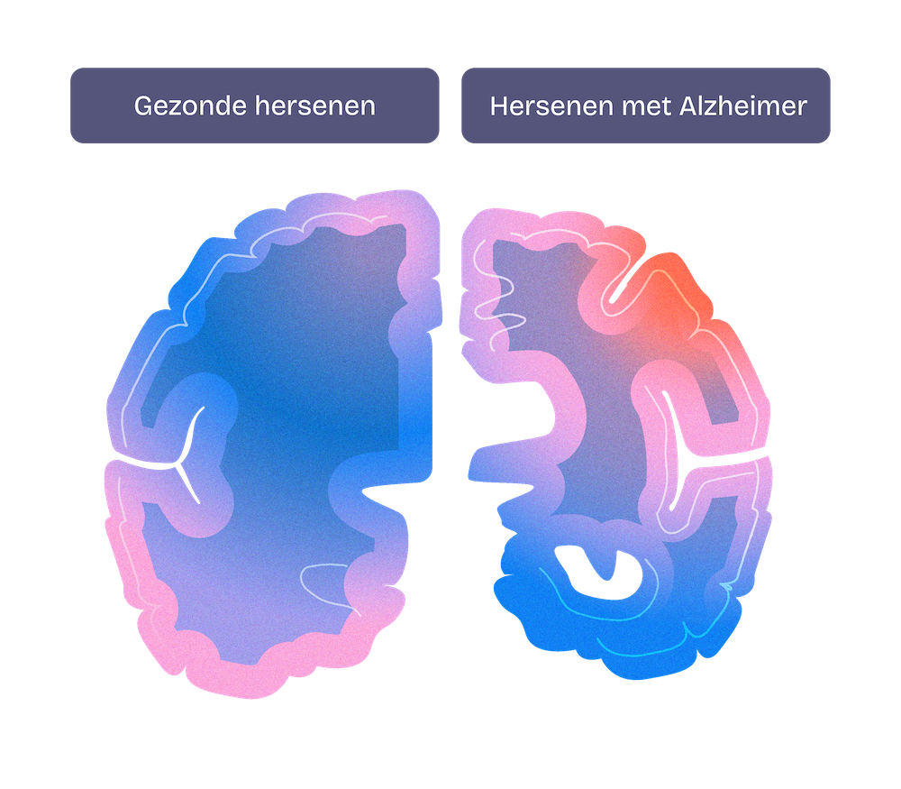 Side-by-side comparison of a normal brain and a brain with Alzheimer's showing significant shrinkage and tissue loss in the Alzheimer's brain.